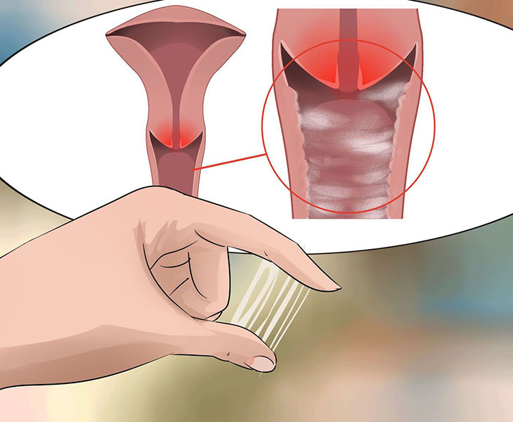 Huyết trắng có sợi máu khi mang thai do viêm âm đạo