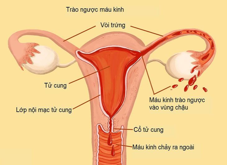 Bệnh lạc nội mạc tử cung có nhiều cách điều trị