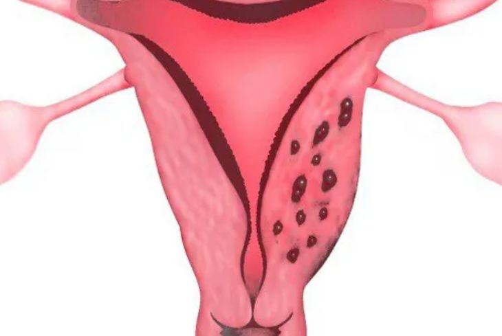 Lạc nội mạc tử cung vết mổ đẻ thường xảy ra ở lứa tuổi 29 đến 31