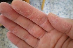 Lột da tay bị ngứa cảnh báo bệnh lý gì?