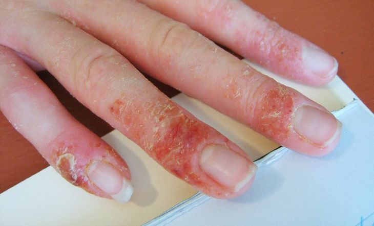 Có nhiều nguyên nhân dẫn đến tình trạng da tay bị tổn thương dẫn đến lột da tay và ngứa