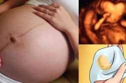 Nấm âm đạo khi mang thai: Nguyên nhân, triệu chứng và cách điều trị