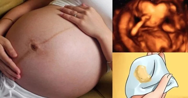 Nấm âm đạo khi mang thai: Nguyên nhân, triệu chứng và cách điều trị