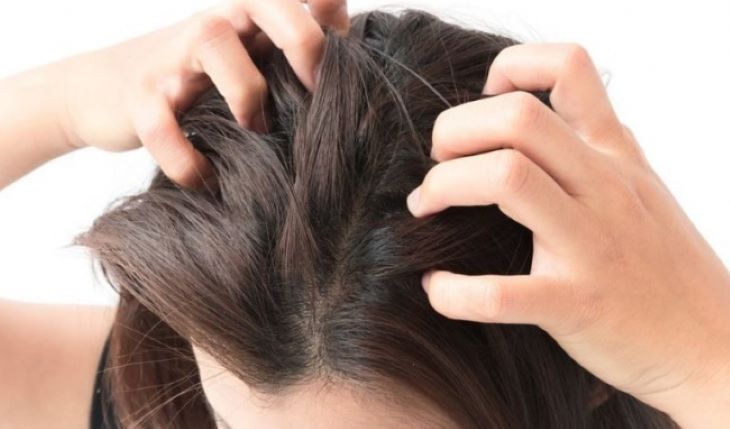 Ngứa da đầu là bệnh gì? Cách chữa