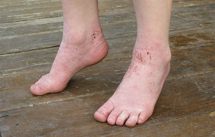 Bệnh tổ đỉa ở chân cũng là một trong những nguyên nhân gây ngứa gót chân