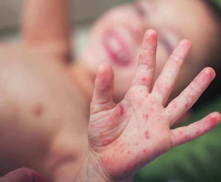 Trẻ bị ngứa loét da có thể là dấu hiệu của bệnh tổ đỉa
