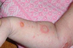 Triệu chứng ngứa loét da ở trẻ em có thể là dấu hiệu bệnh nguy hiểm