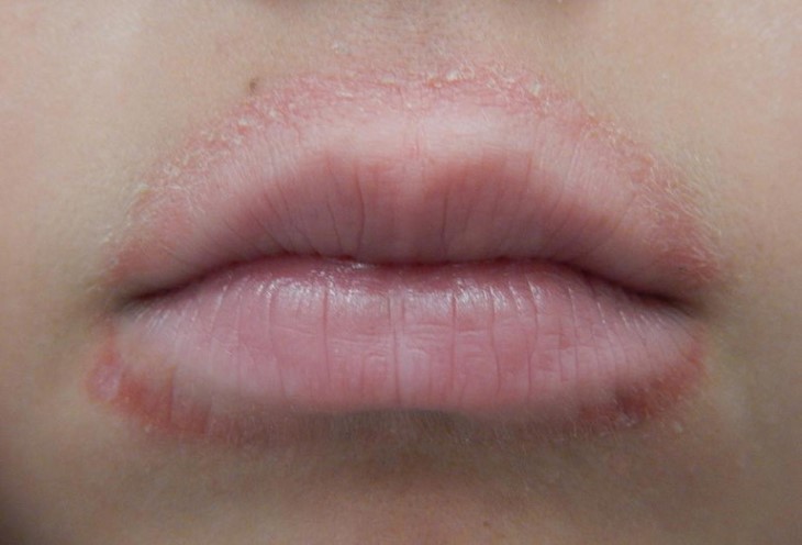 Chàm môi không chỉ gây ngứa quanh miệng mà còn ảnh hưởng đến thẩm mỹ