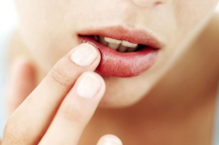 Bôi thuốc để khắc phục tình trạng ngứa quanh miệng và chàm môi