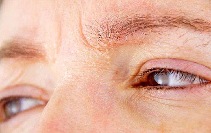 Ngứa vùng da quanh mắt là bệnh gì? Điều trị thế nào?