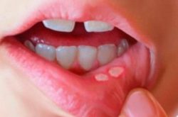 Nhiệt miệng là bệnh lý gây ra nhiều sự khó chịu cho người bệnh