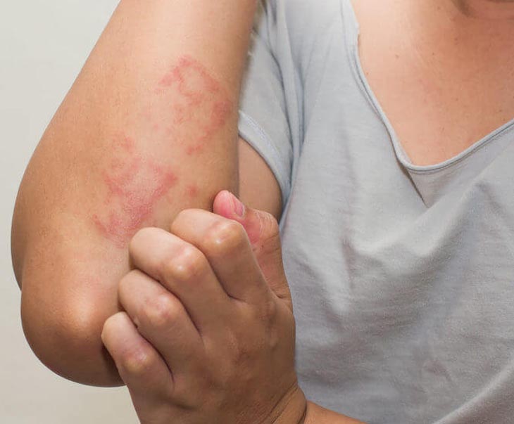 Nổi mề đay ở tay khiến nhiều người bệnh lo lắng