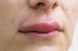 Mề đay sưng môi khiến người bệnh khó chịu, ảnh hưởng đến đời sống