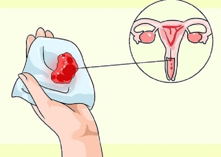 Rong kinh sau hút thai thường do ảnh hưởng của nội tiết hoặc bị dính tử cung