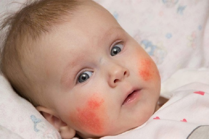 Trẻ có nguy cơ bị viêm da cơ địa cao khi có bố hoặc mẹ mắc bệnh