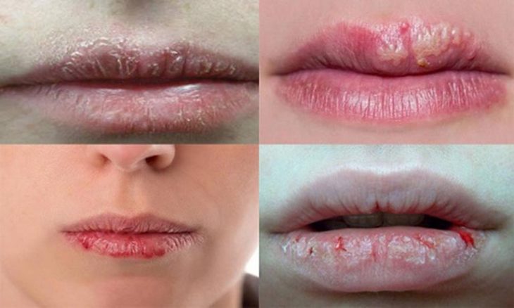 Triệu chứng bệnh chàm môi
