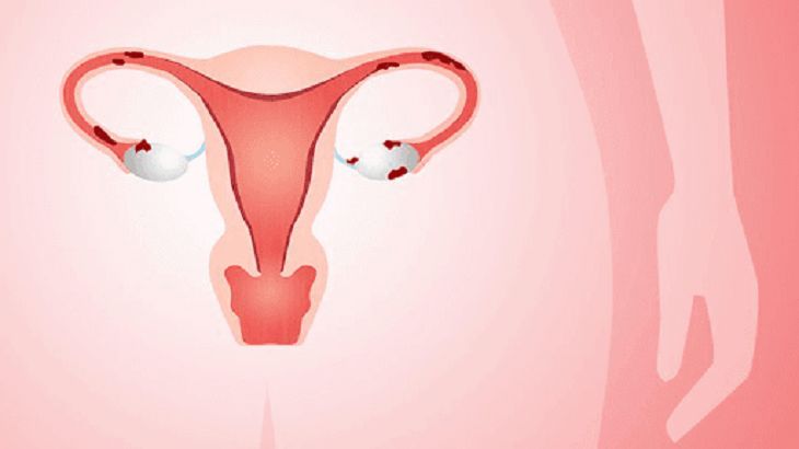 U lạc nội mạc tử cung là gì?
