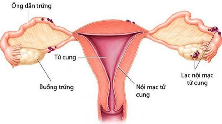 U lạc nội mạc tử cung là gì là thắc mắc của nhiều chị em phụ nữ