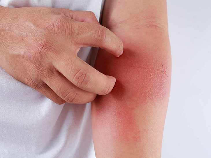 Uống rượu nổi mề đay có nguy hiểm không?