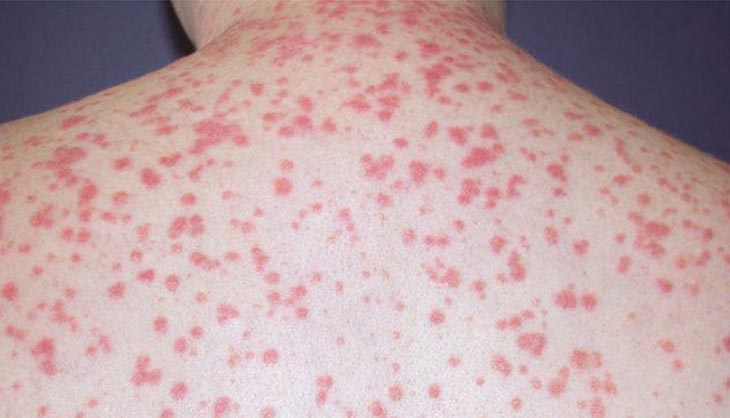 Vảy nến thể giọt gây ra nhiều bất tiện cho người bệnh