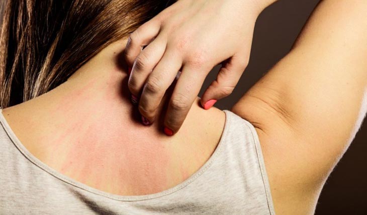 Ngứa là triệu chứng điển hình mắc vảy nến giọt
