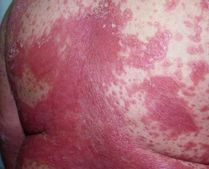 Những vùng da mắc bệnh sẽ lan nhanh chóng ra các vùng da lành trên cơ thể nếu không được điều trị kịp thời