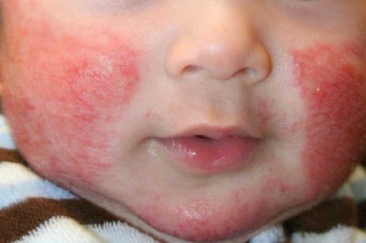 Trẻ bị viêm da cơ địa bội nhiễm