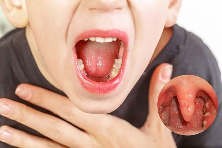 Viêm họng mãn tính là gì? Viêm họng mãn tính ảnh hưởng đến người có hệ miễn dịch yếu như trẻ em