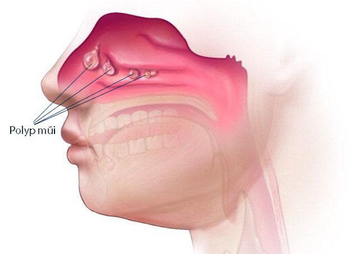 Viêm xoang Polyp mũi là bệnh lý khá phổ biến hiện nay
