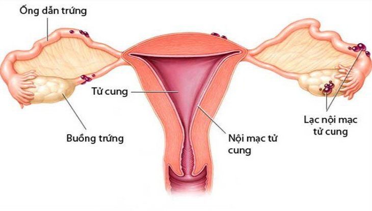 Lạc nội mạc tử cung xảy ra ở phụ nữ độ tuổi sinh sản
