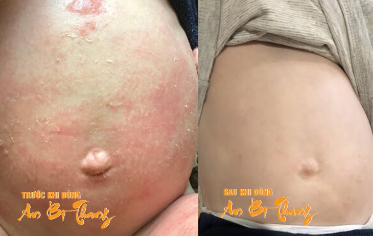 Hình ảnh trước và sau khi điều trị chàm của bé Hoàng Anh (8 tháng tuổi) - con trai chị Phạm Nga (Yên Định, Thanh Hóa)