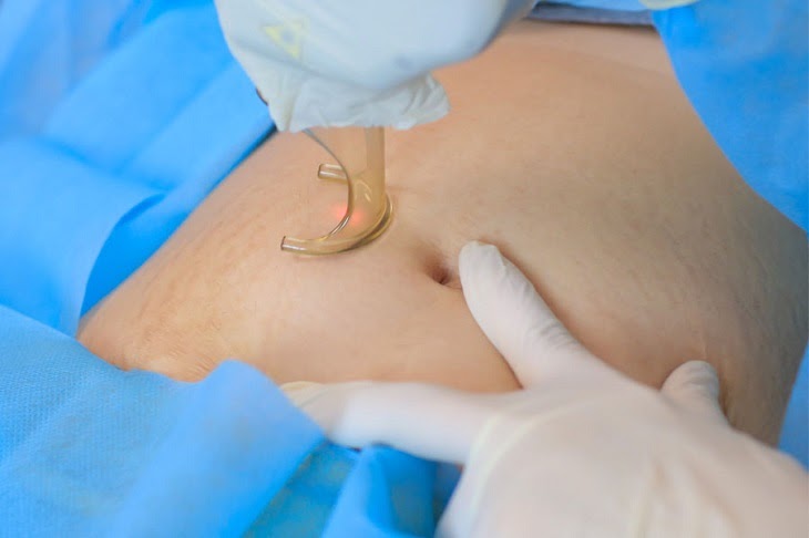 Điều trị Laser giúp loại bỏ vết rạn lâu năm ở những phụ nữ sau sinh