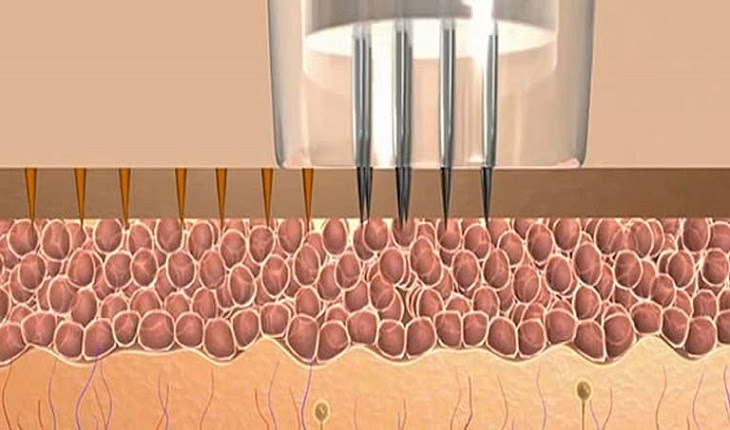Phương pháp lăn kim kích hoạt sản xuất collagen và elastin
