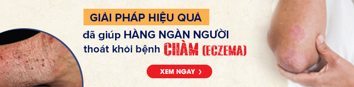 banner an bi thang chua cham eczema
