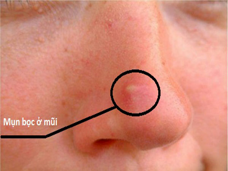 Mụn bọc ở mũi xuất hiện khiến người bị cảm thấy đau nhức, khó chịu