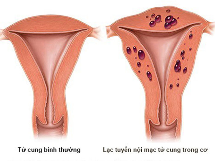 Lạc nội mạc trong cơ tử cung là tình trạng nội mạc “đi lạc” vào lớp cơ của tử cung