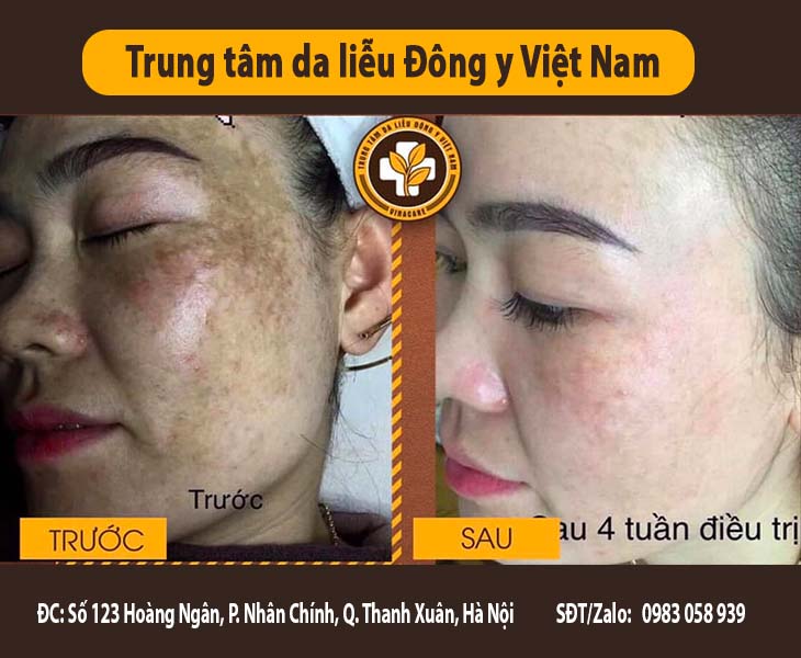 Bệnh nhân trước và sau 1 tháng sử dụng bộ sản phẩm Nám da Tàn nhang Vương Phi