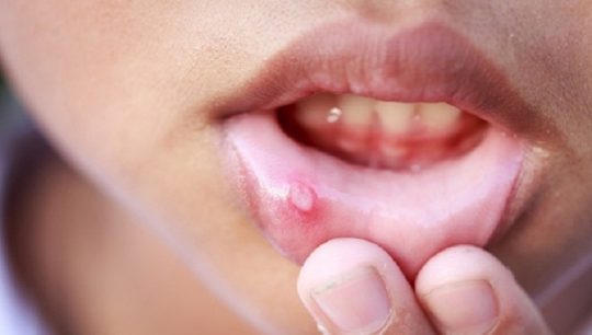 Nhiệt miệng có lây không?