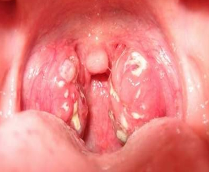 Viêm họng hạt ở trẻ em là tình trạng viêm nhiễm vùng niêm mạc hầu họng