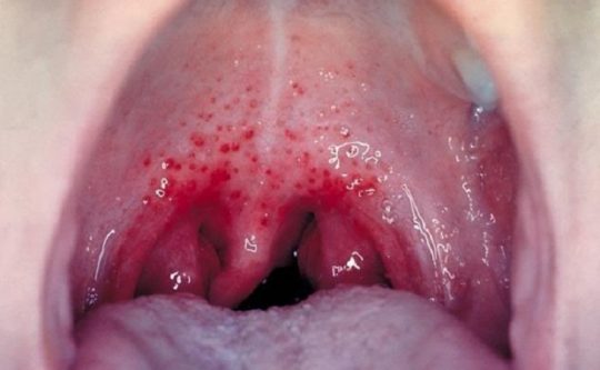 Viêm họng liên cầu khuẩn: Dấu hiệu và cách điều trị