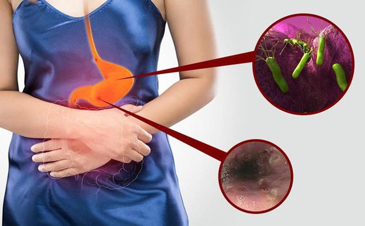 Tìm hiểu viêm loét dạ dày tá tràng có nguy hiểm không