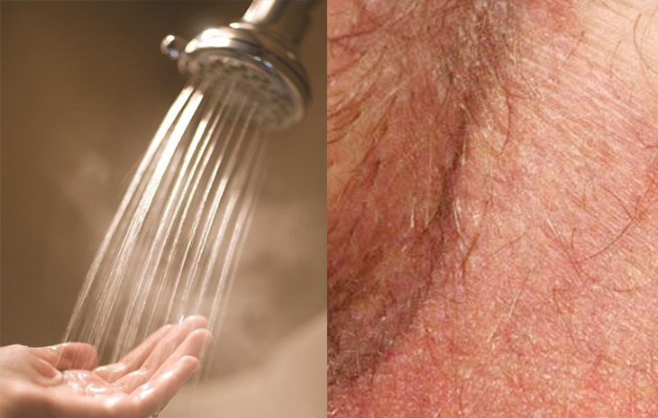 Rửa vùng da bị hắc lào ở háng với nước ấm giúp người bệnh dễ chịu hơn