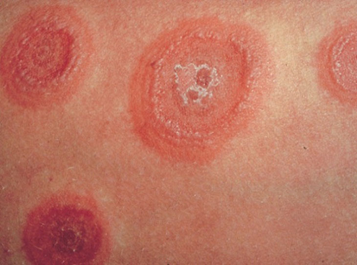 Những mảng da đỏ, hình đồng xu như thế này chính là triệu chứng điển hình của bệnh hắc lào ở mông