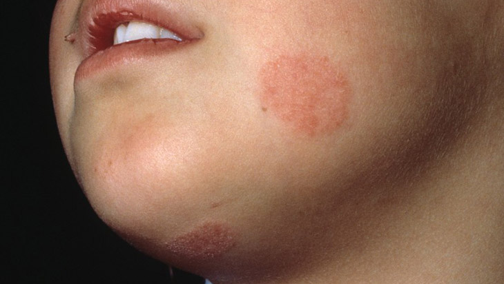Hắc lào ở mặt trẻ thường bị nhầm lẫn với một số bệnh ngoài da khác, như chàm hoặc khô da
