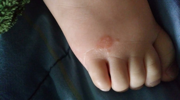 Nấm da chân ít khi xuất hiện ở trẻ sơ sinh