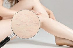 Rạn da chân rất dễ nhận thấy và nam hay nữ cũng đều có thể bị