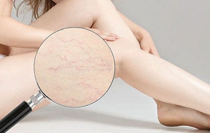 Rạn da chân rất dễ nhận thấy và nam hay nữ cũng đều có thể bị
