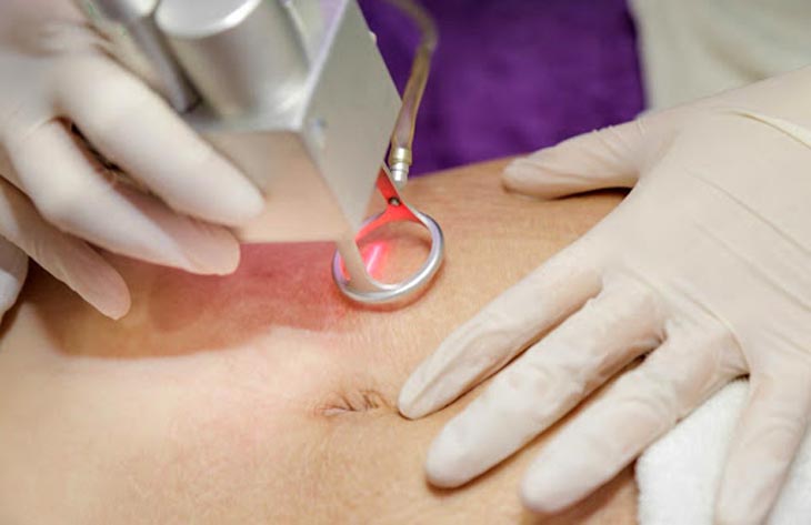 Công nghệ Fractional Laser được đánh giá là mang lại hiệu quả trị rạn da nói chung nhanh nhất hiện nay
