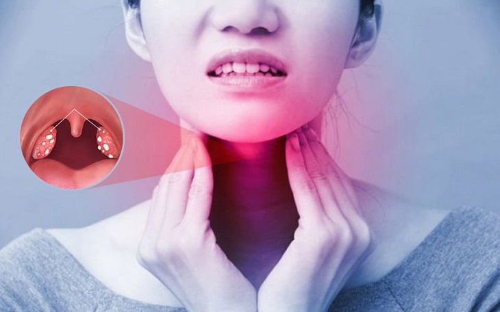 Bệnh viêm amidan quá phát có thể do nhiều nguyên nhân gây ra
