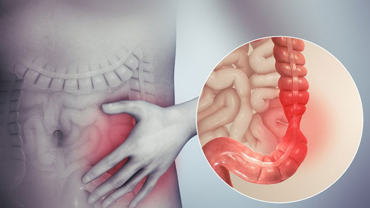 Hội chứng ruột kích thích là tình trạng rối loạn tiêu ảnh hưởng đến sức khỏe và cuộc sống của người bệnh